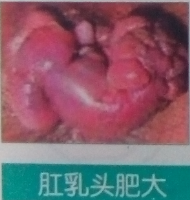 肛乳头肥大.png