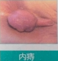 内痔.png