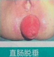 直肠脱垂.png