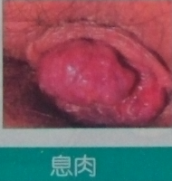 息肉.png